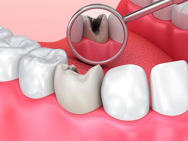 Лечение каналов зуба: чистка, пломбирование